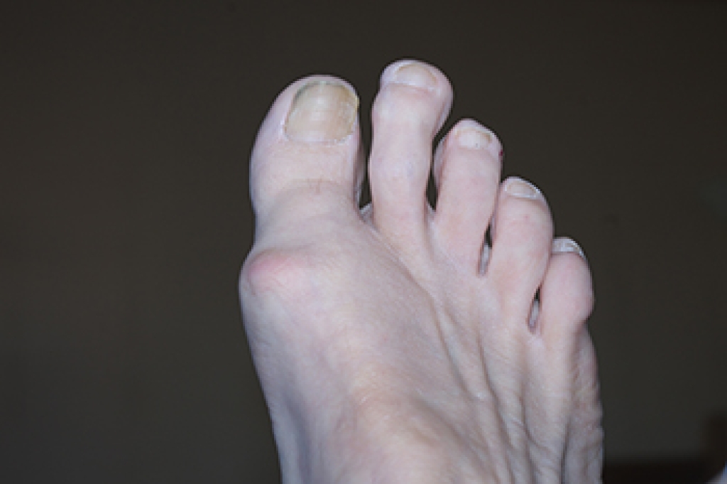 Understanding Morton's Toe