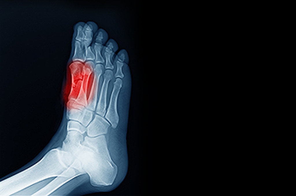 Risk Factors for Sesamoiditis