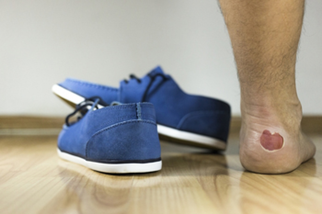 Foot Blisters and Their Causes