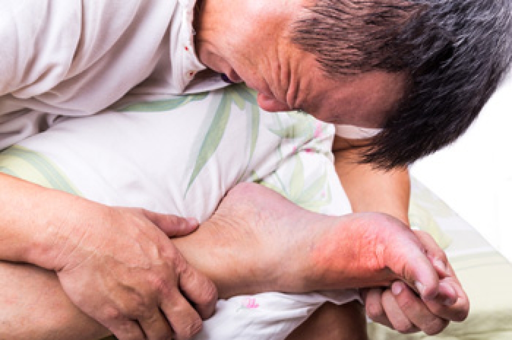 Why Gout Flares Cause Severe Foot Pain