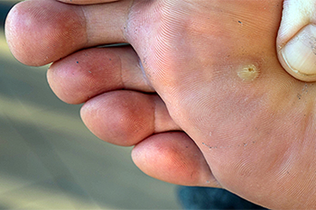 What Are Plantar Warts?