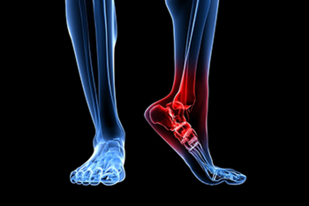 Diagnosing Heel Stress Fractures